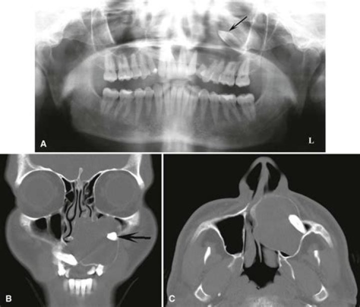 Can a maxillary cyst burst?