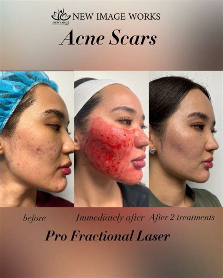 When can I wash my face after ProFractional laser?